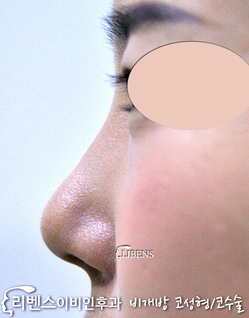코끝만 수술 성형 무보형물 코끝 연골묶기 비중격 연골 삽입 성형 s99